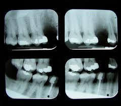 Диагностика перед зубной имплантацией